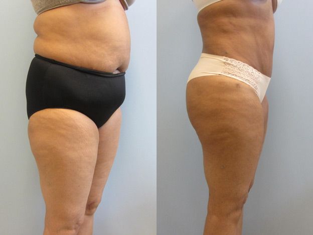 Tummy Tuck Before & After