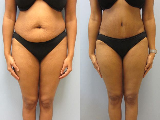 Tummy Tuck Before & After