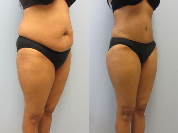 Tummy Tuck Before & After