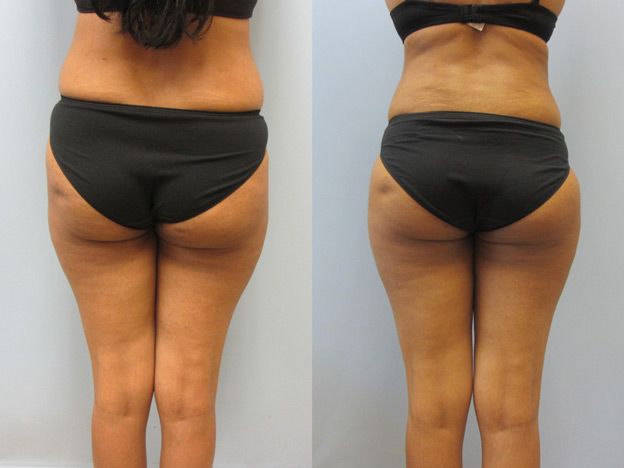 Tummy Tuck Before & After