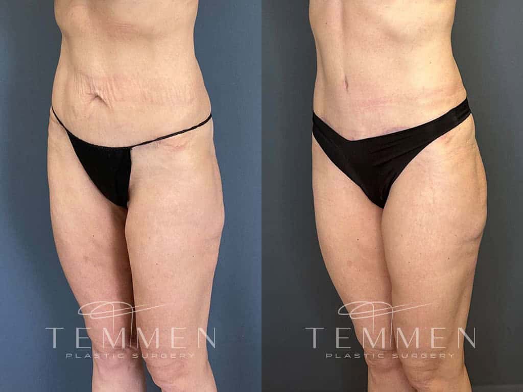 Tummy Tuck Before & After