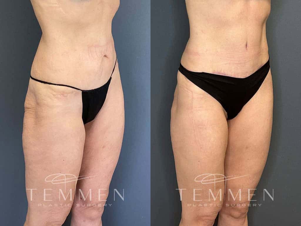 Tummy Tuck Before & After