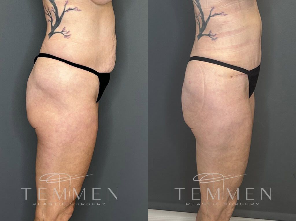 Tummy Tuck Before & After