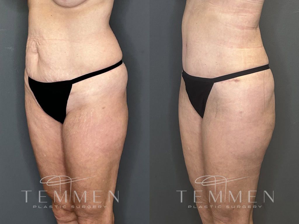 Tummy Tuck Before & After