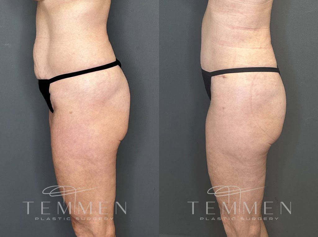 Tummy Tuck Before & After