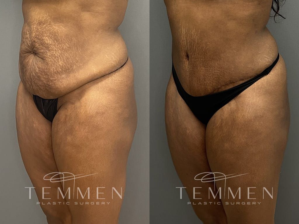 Tummy Tuck Before & After
