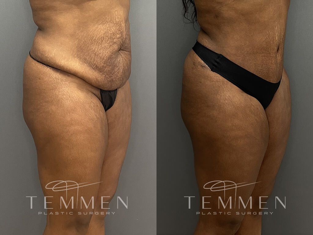 Tummy Tuck Before & After