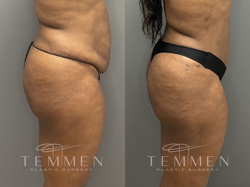 Tummy Tuck Before & After