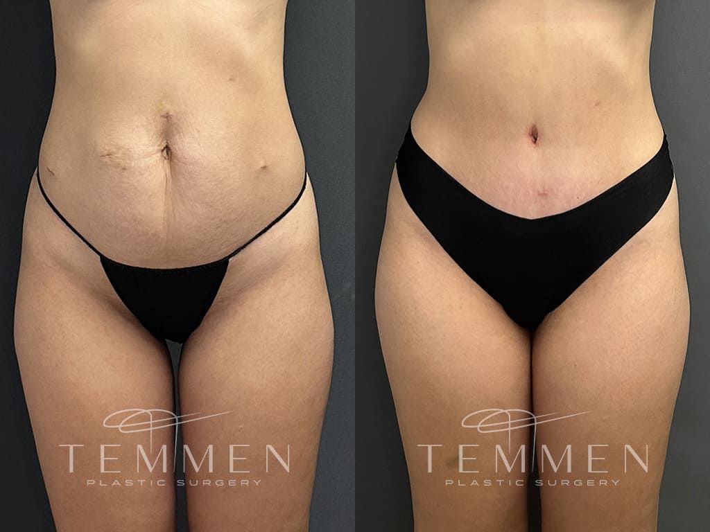 Tummy Tuck Before & After