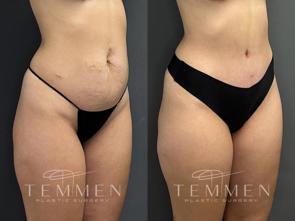 Tummy Tuck Before & After