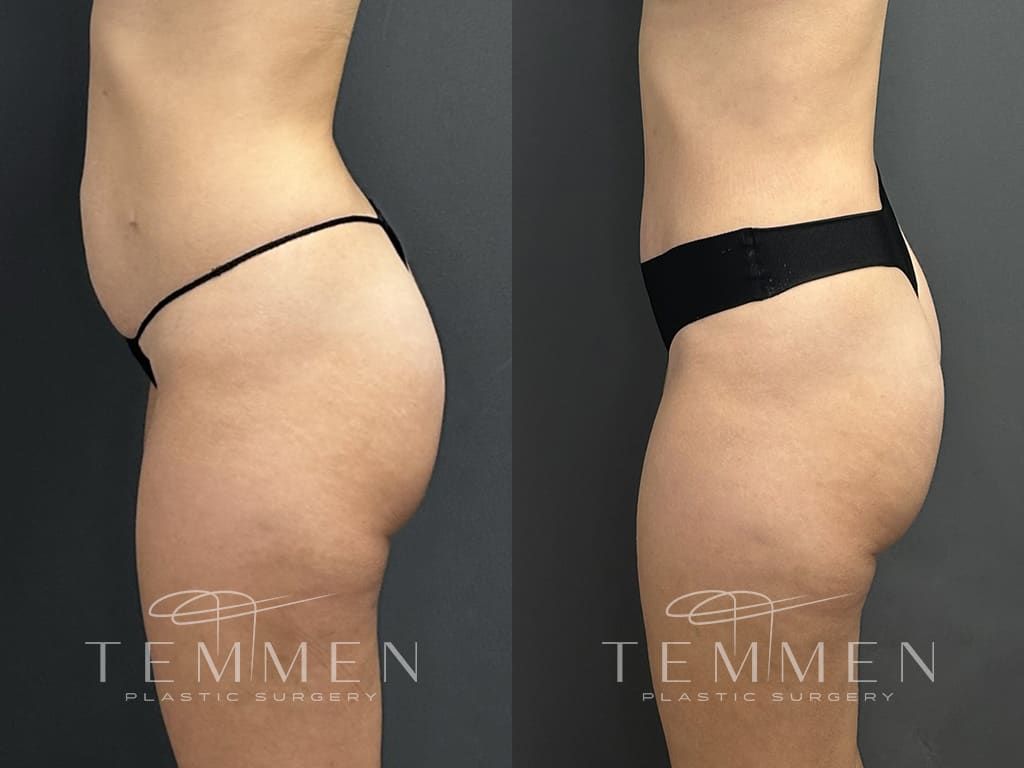 Tummy Tuck Before & After