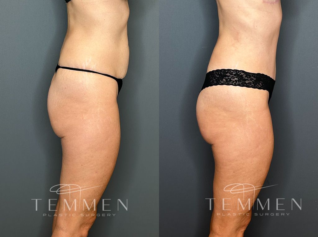 Tummy Tuck Before & After