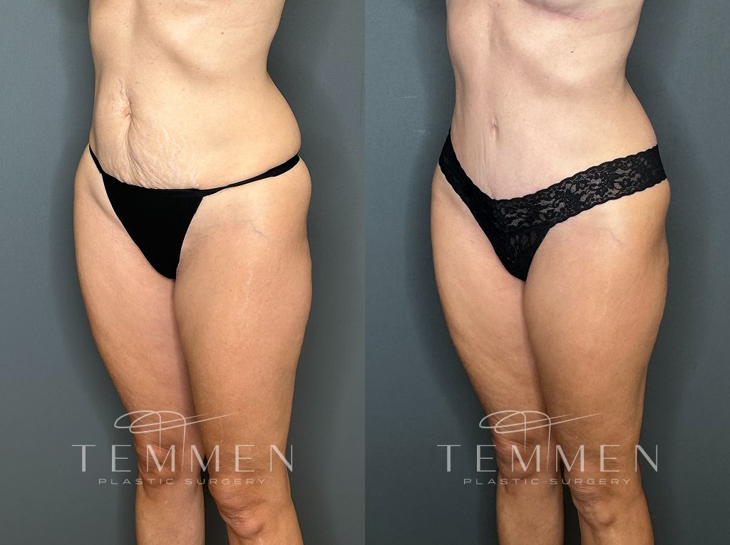 Tummy Tuck Before & After