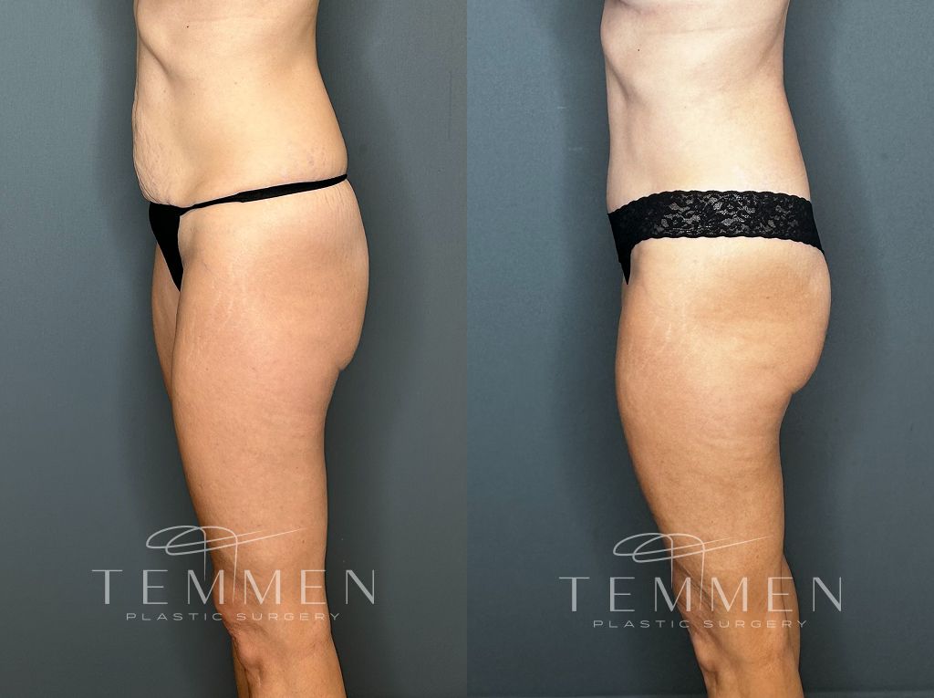 Tummy Tuck Before & After
