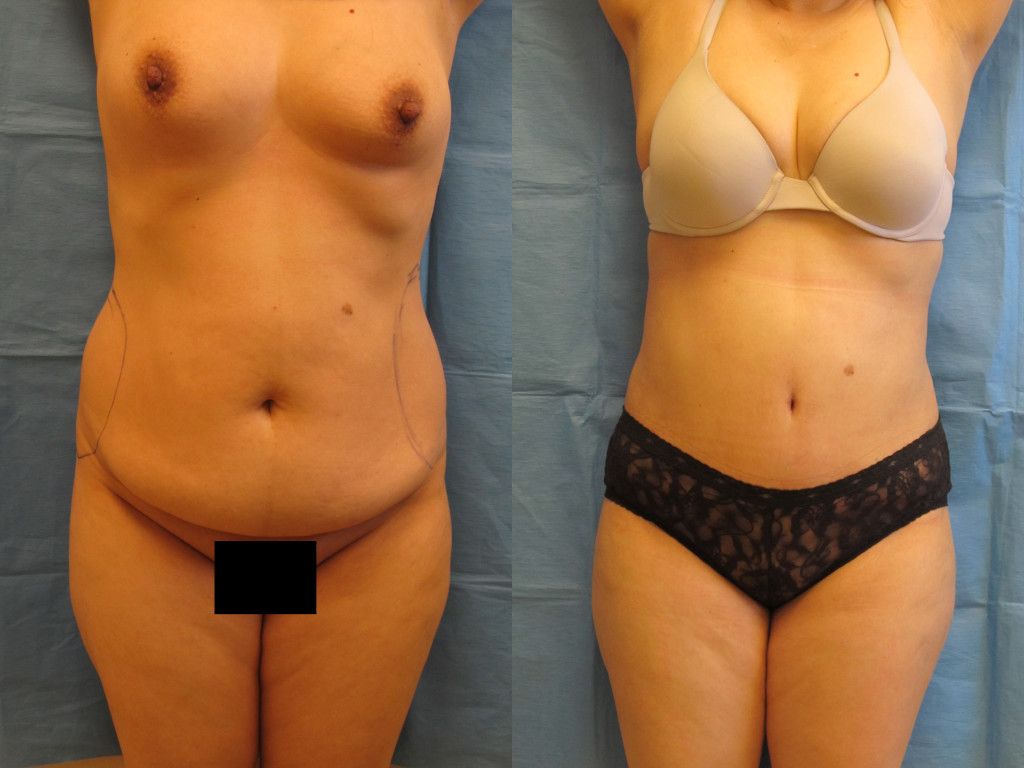 Tummy Tuck Before & After