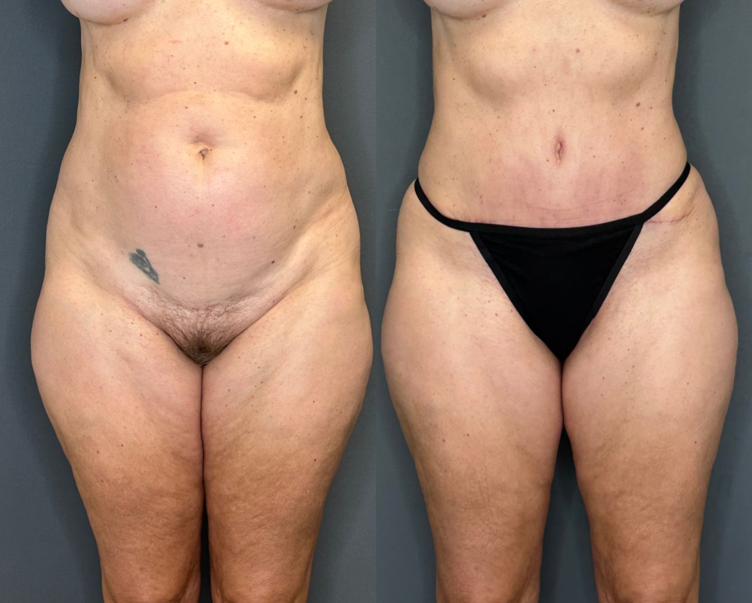 Tummy Tuck Before & After
