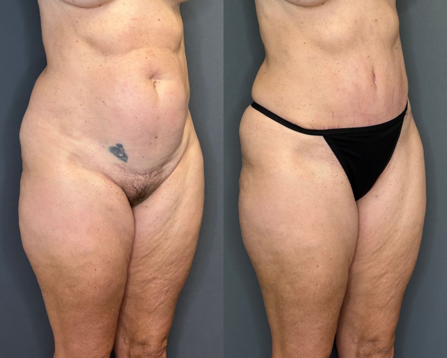 Tummy Tuck Before & After