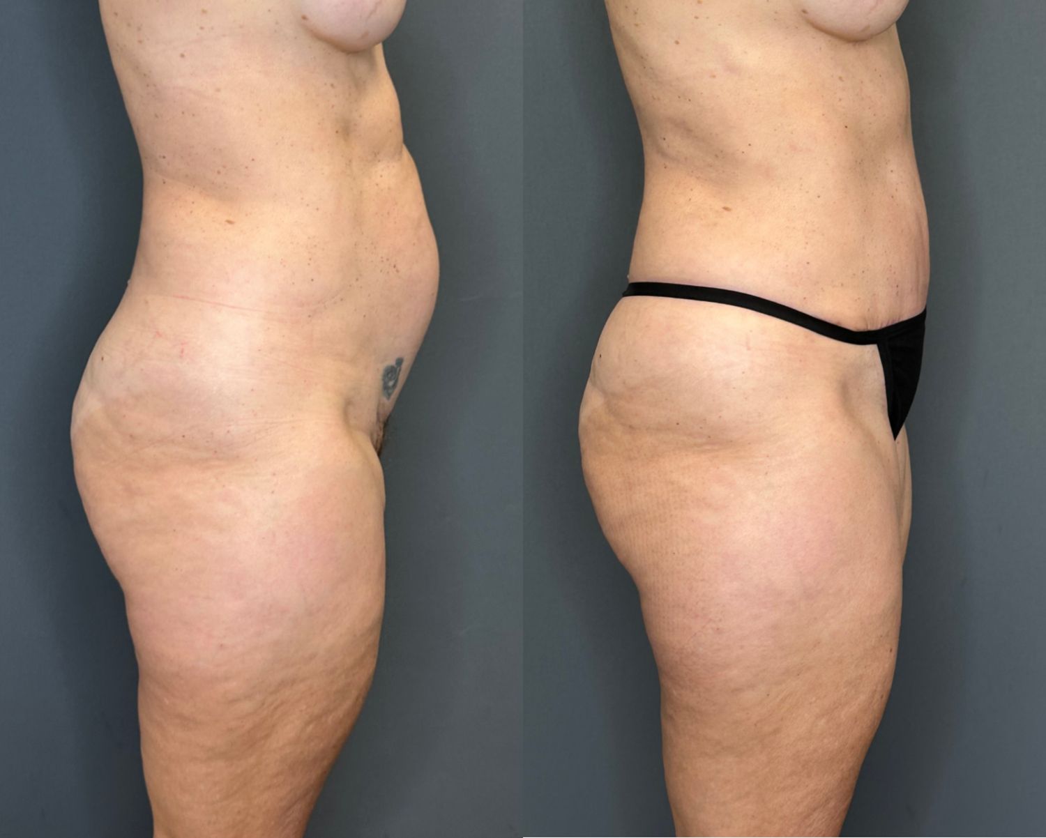 Tummy Tuck Before & After