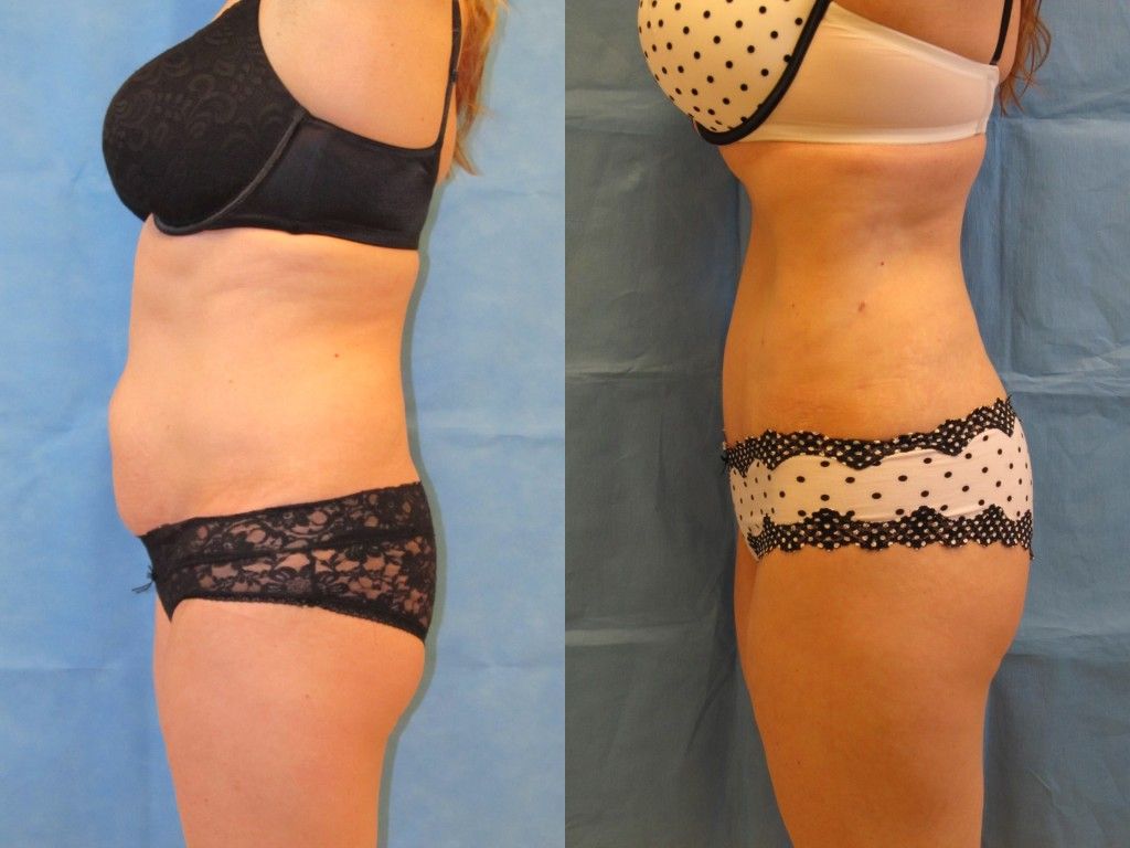 Tummy Tuck Before & After
