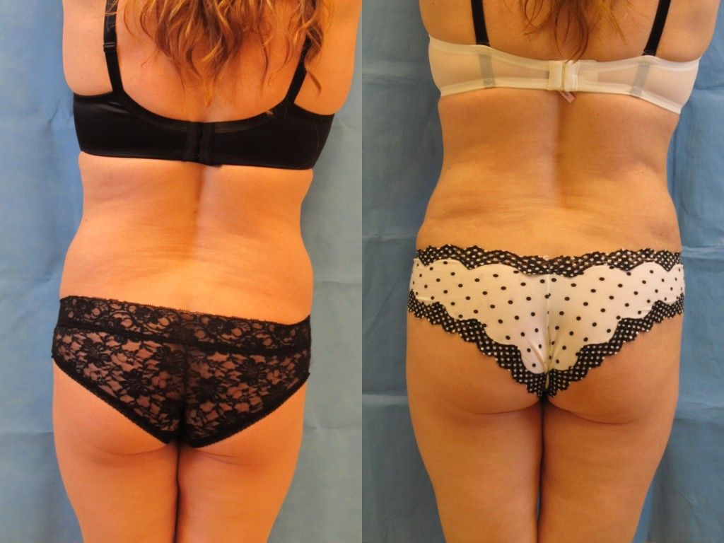 Tummy Tuck Before & After