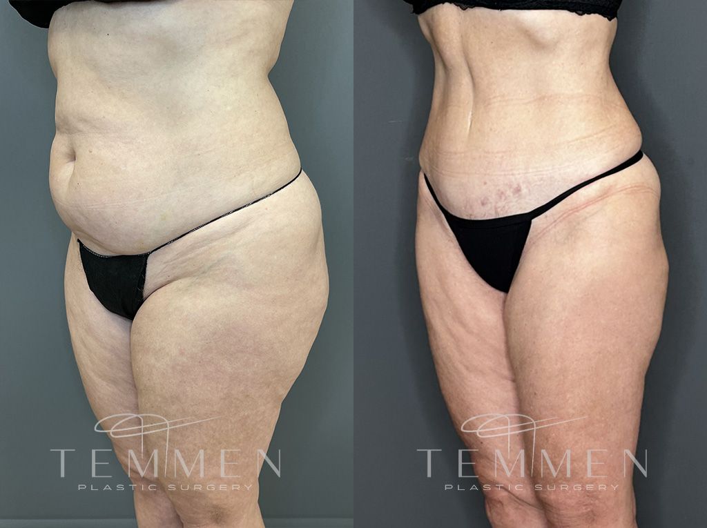 Tummy Tuck Before & After