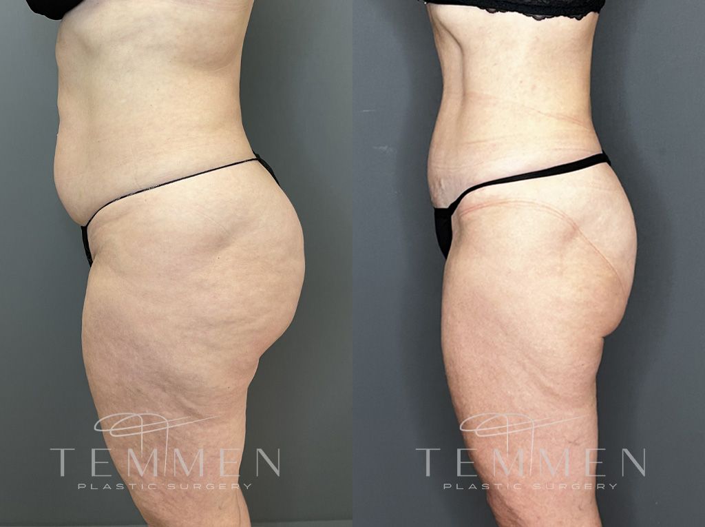 Tummy Tuck Before & After