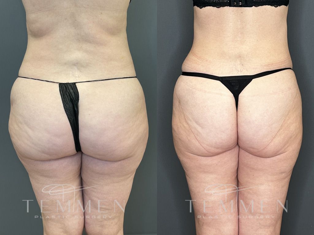Tummy Tuck Before & After