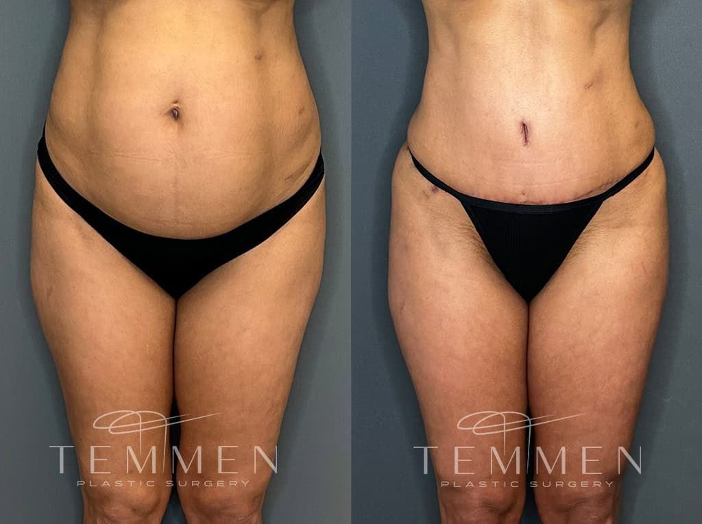 Tummy Tuck Before & After