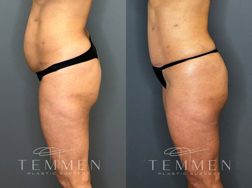 Tummy Tuck Before & After