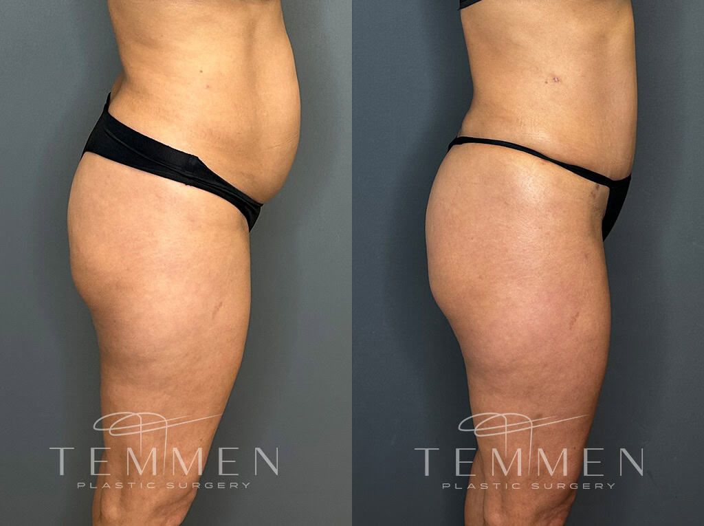 Tummy Tuck Before & After