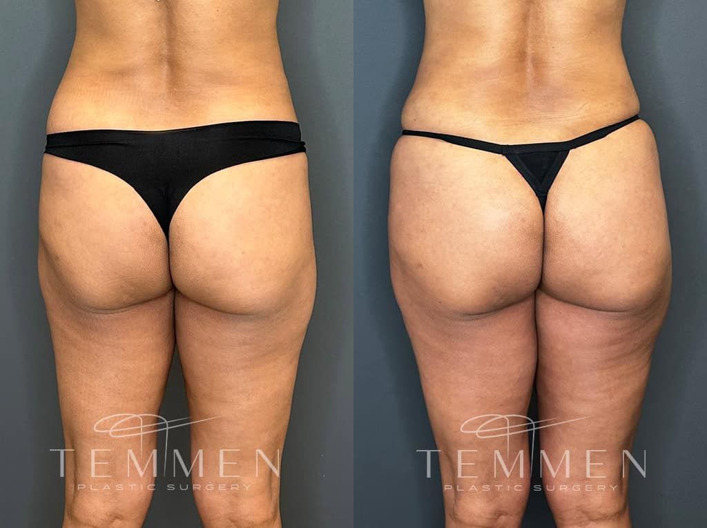 Tummy Tuck Before & After