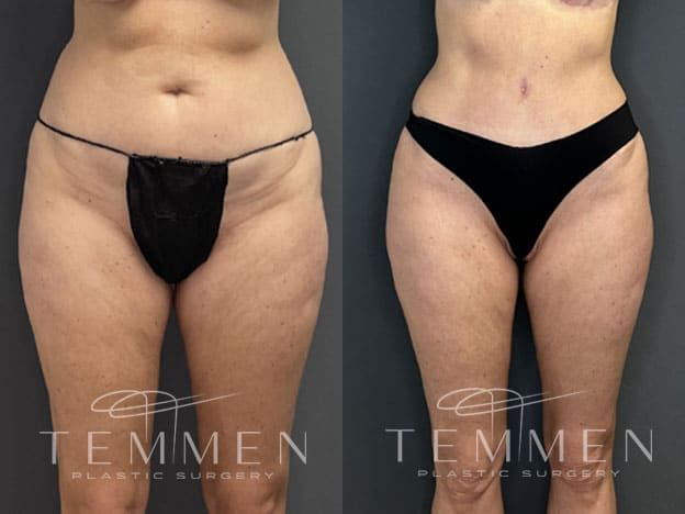 Tummy Tuck Before & After