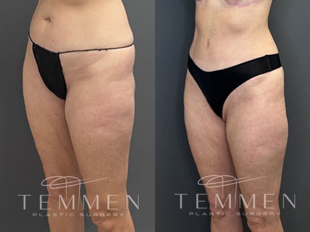 Tummy Tuck Before & After
