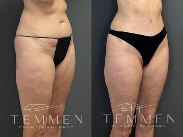 Tummy Tuck Before & After