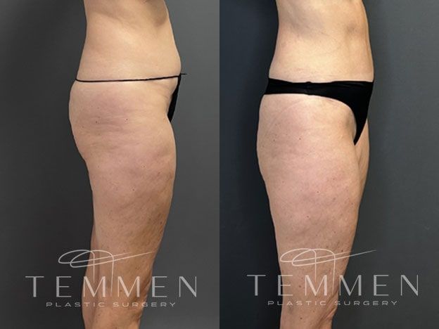 Tummy Tuck Before & After