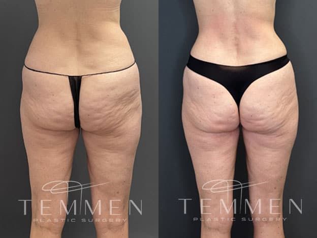 Tummy Tuck Before & After