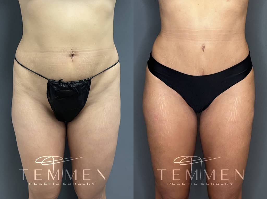 Tummy Tuck Before & After