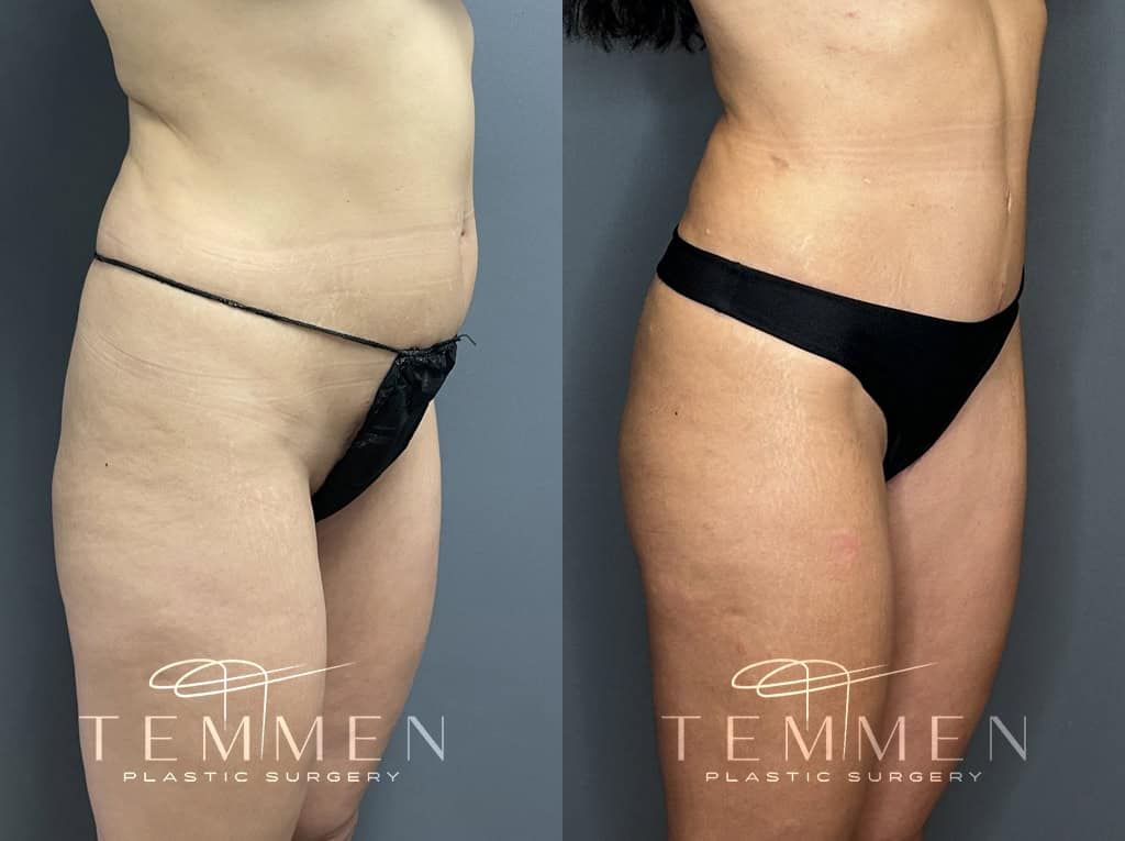 Tummy Tuck Before & After
