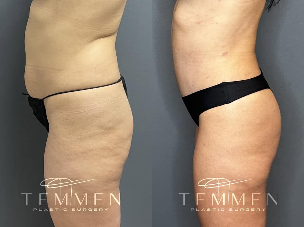 Tummy Tuck Before & After