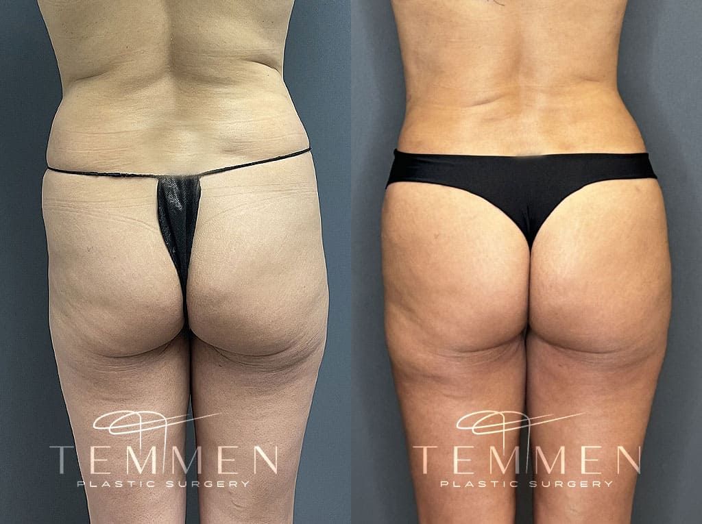 Tummy Tuck Before & After