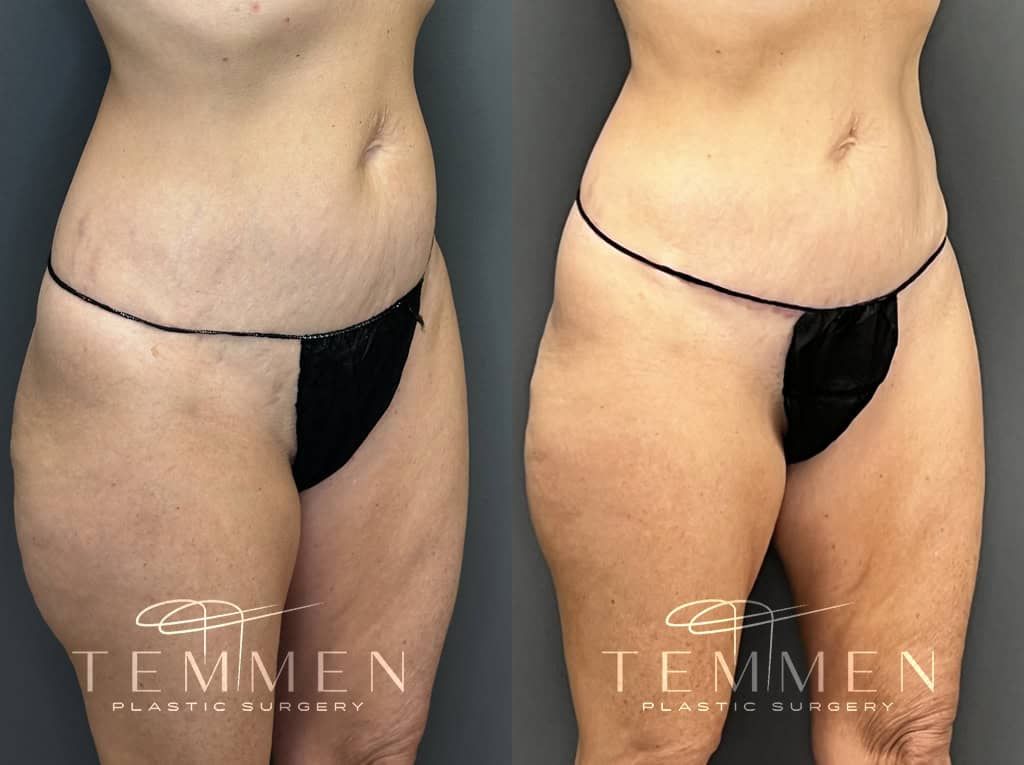 Tummy Tuck Before & After