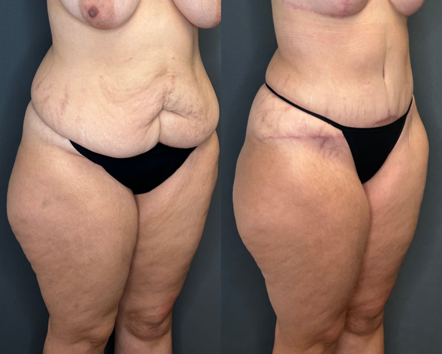Tummy Tuck Before & After
