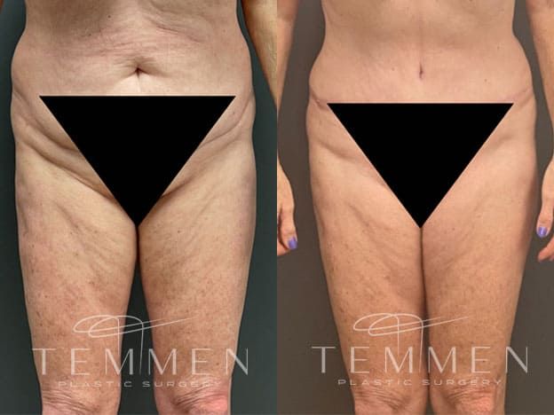 Tummy Tuck Before & After