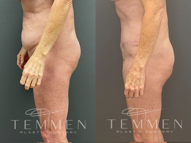 Tummy Tuck Before & After