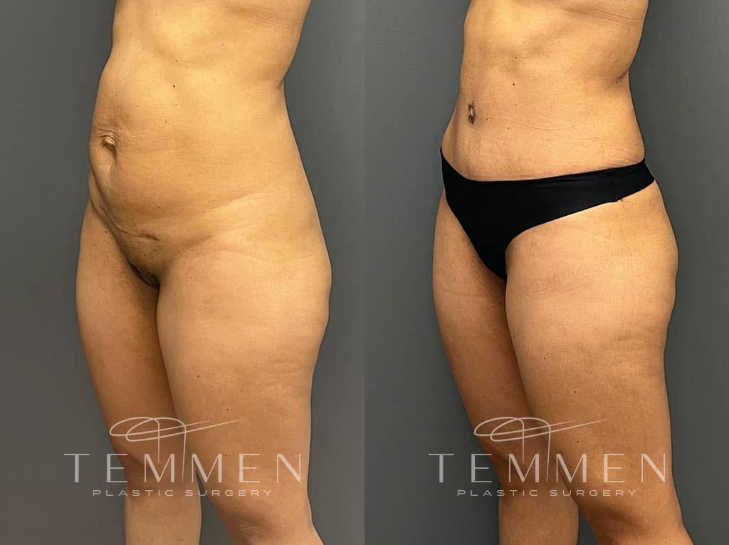 Tummy Tuck Before & After