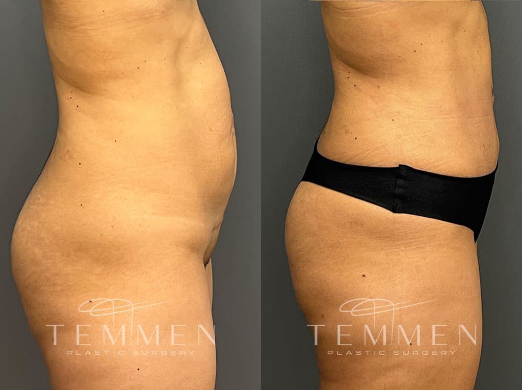 Tummy Tuck Before & After