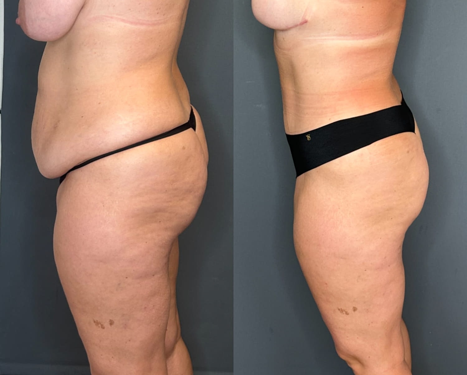 Tummy Tuck Before & After
