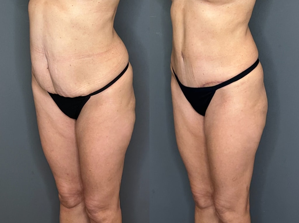 Tummy Tuck Before & After