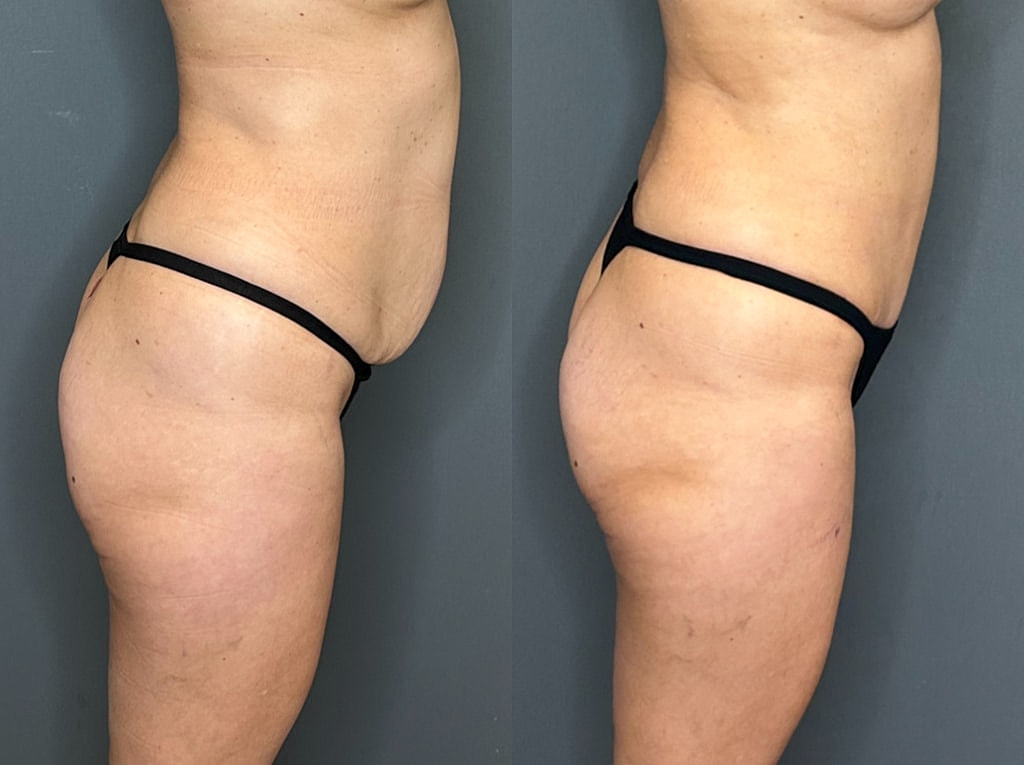 Tummy Tuck Before & After