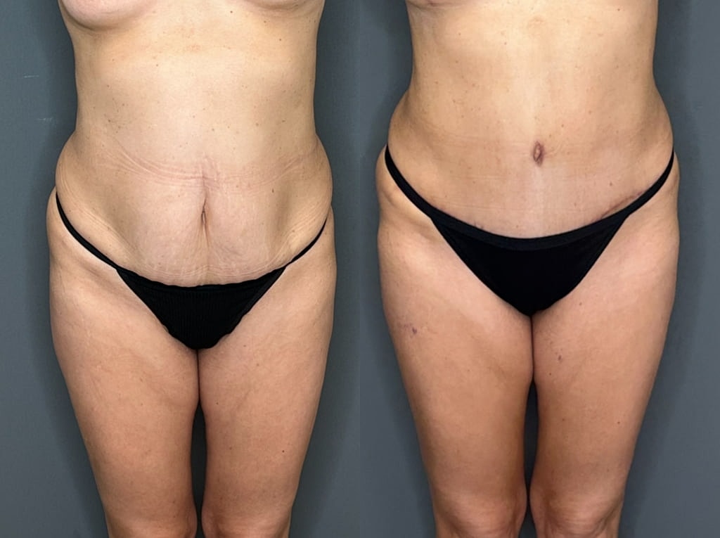 Tummy Tuck Before & After